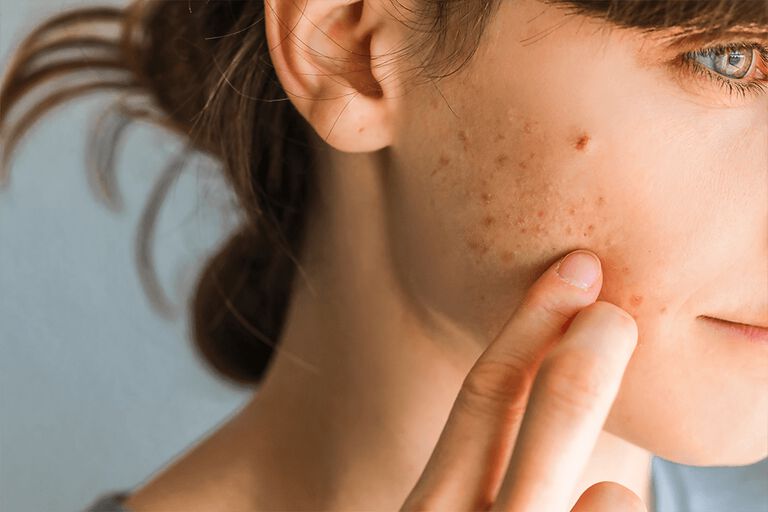 https://www.multipharma.be/dw/image/v2/BDGN_PRD/on/demandware.static/-/Library-Sites-MultipharmaSharedLibrary/default/dwac5e0226/Home/Category%20Landing%20Pages/Acne%20behandeling/acne-article-1-981x654.jpg?sw=768&sfrm=png
