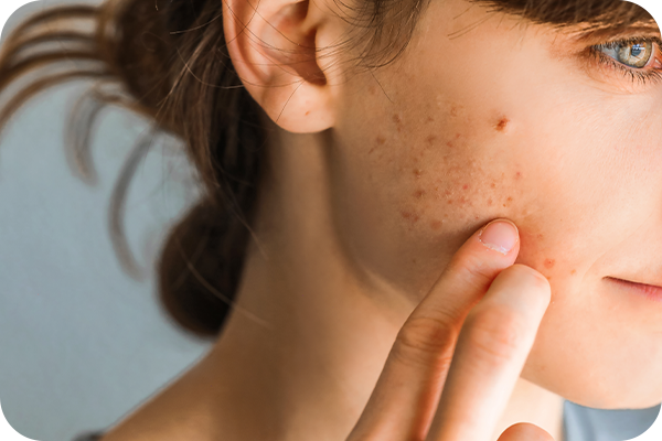 https://www.multipharma.be/dw/image/v2/BDGN_PRD/on/demandware.static/-/Library-Sites-MultipharmaSharedLibrary/default/dwcd18c629/Home/Category%20Landing%20Pages/Acne%20behandeling/tt-acne-newsletter-article-2.png