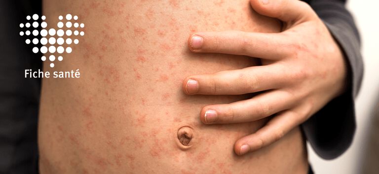 https://www.multipharma.be/dw/image/v2/BDGN_PRD/on/demandware.static/-/Library-Sites-MultipharmaSharedLibrary/fr_BE/dw2e034928/Home/Health%20Issues/Infection/VZV/fs-zona-981x451-fr.jpg?sw=768&sfrm=png